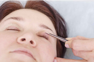 Beneficios de la blefaroplastia láser