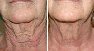 antes y después hilos tensores