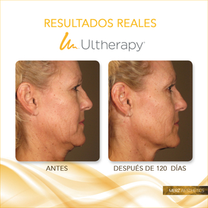 lifting sin cirugía con ultherapy