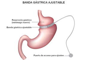 ¿Cómo se ve la banda gástrica?