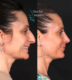 Antes y después de una rinoplastia