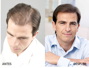 antes y después microinjertos