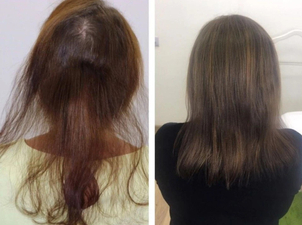 tratamientos alopecia