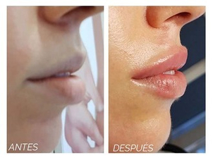 Antes y después queiloplastia
