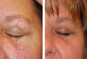 antes y después corrección de cicatrices