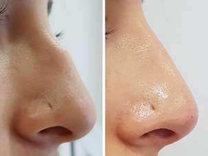 antes y después rinomodelación