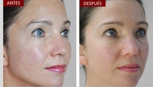 rejuvenecimiento facial