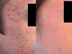 antes y después tratamiento antiacné