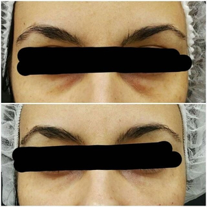 antes y después tratamiento ojeras