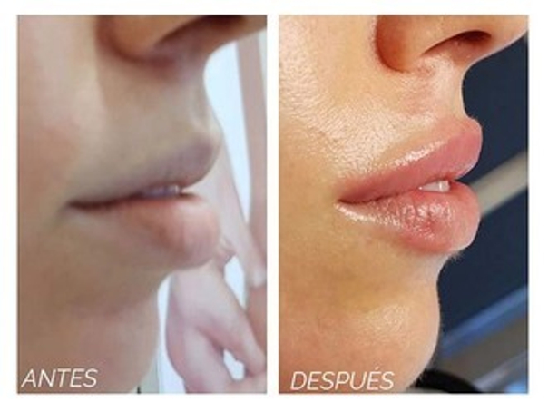 aumento de labios