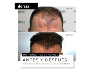 Antes y después microinjertos capilares