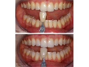 antes y después blanqueamiento dental
