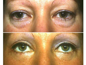 antes y después blefaroplastia sin ciurgía