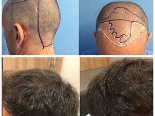 antes y después trasplante capilar