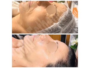 antes y después rejuvenecimiento facial