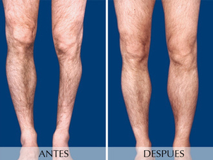 antes y después aumento de gemelos