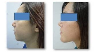 mentoplastia con prótesis anatómicas