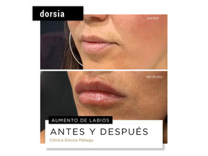 aumento de labios con ácido hialurónico