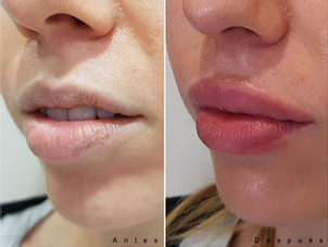 antes y después lipofilling