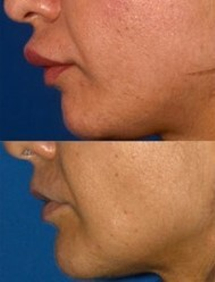 Queiloplastia