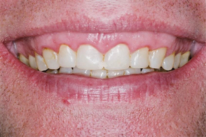Sonrisa gingival