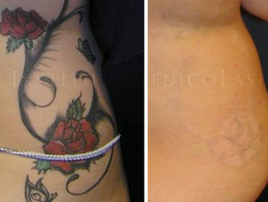 ventajas eliminación tatuajes