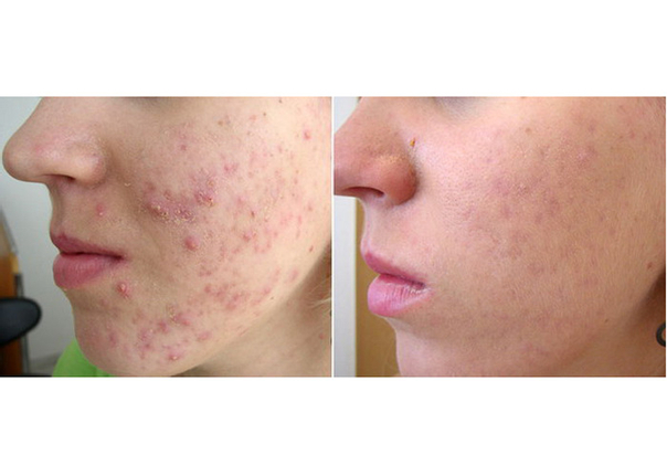 antes y después tratamiento anti acné
