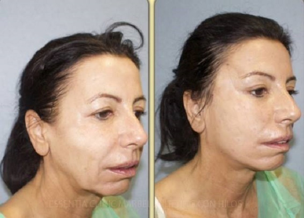 lifting facial sin cirugía