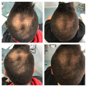 antes y después microinjertos