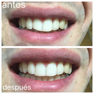 antes y después carillas dentales