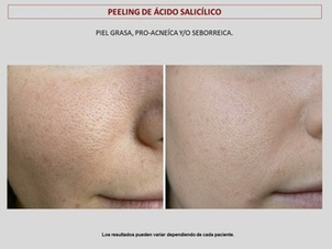 antes y después peeling