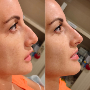 antes y después rinomodelación