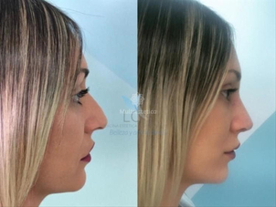 Rinoseptoplastia: antes y después