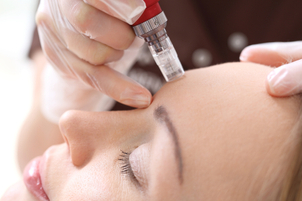 Sesión de microneedling