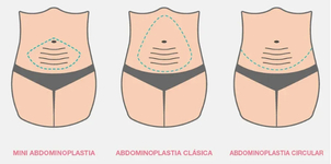 cirujano abdominoplastia