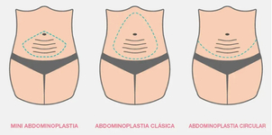 tipos de abominoplatia