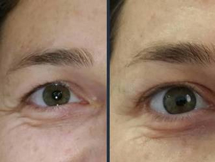 antes y después de una blefaroplastia sin cirugía