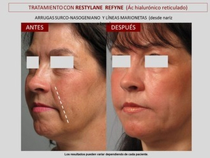 antes y después ácido hialurónico