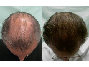 antes y después trasplante capilar