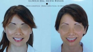 antes y después bichectomía