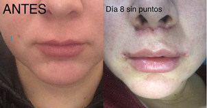 antes y después permalip