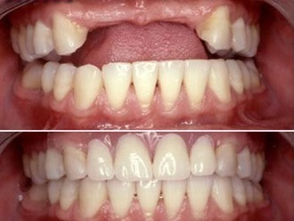 Antes y después de un procedimiento de implante dental.