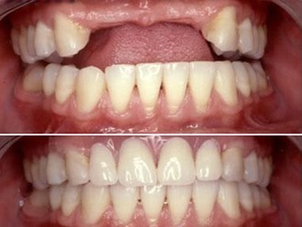 Antes y después de un procedimiento de implante dental.