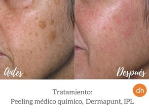 antes y después peeling