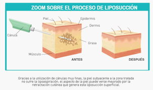 Liposucción