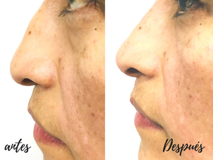 antes y después rinomodelación