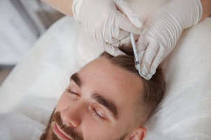 ¿Cómo se realiza la mesoterapia capilar?