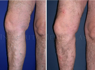 antes y después varices