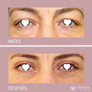 antes y después blefaroplastia láser