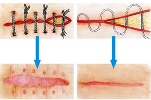 técnicas para corregir las cicatrices